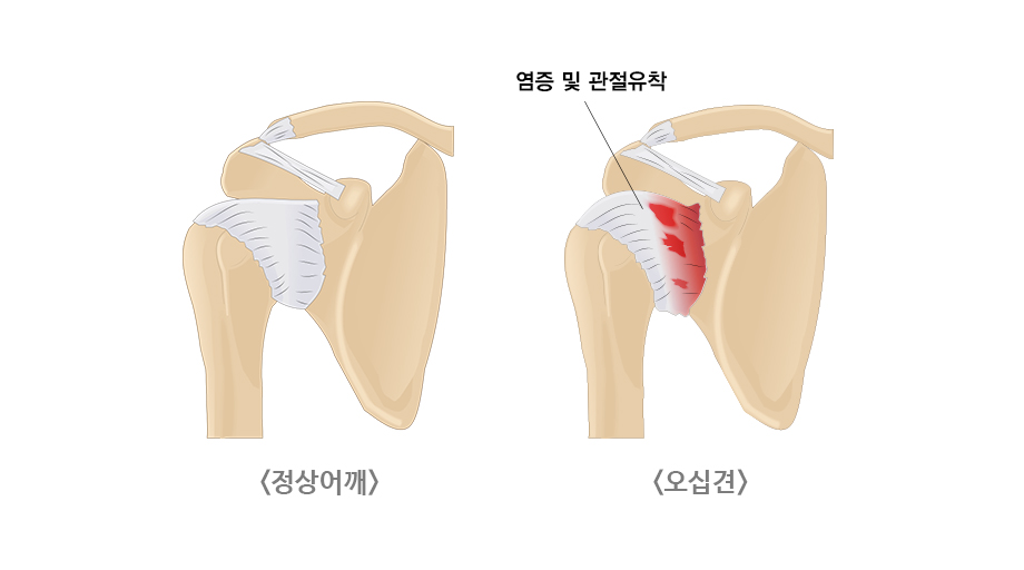 모커리한방병원 정상어깨 / 오십견 -염증 및 관절유착