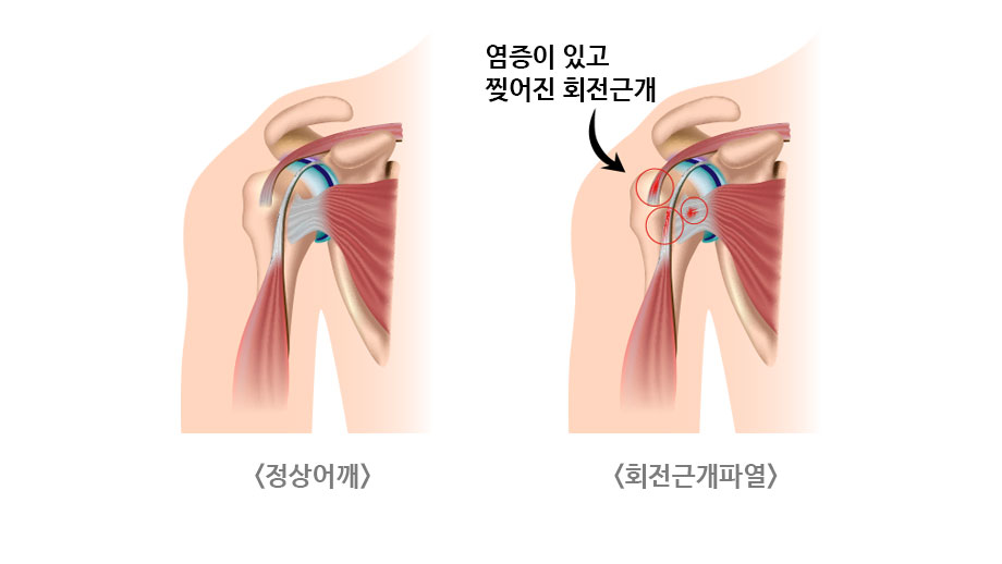 정상어깨 / 회전근개파열