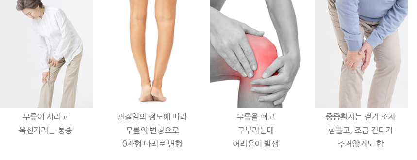 퇴행성 무릎관절염이 의심되는 퇴행성 무릎관절염 증상