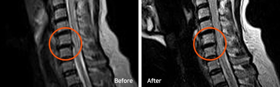 모커리한방병원 목디스크 MRI 전/후 사진 이미지