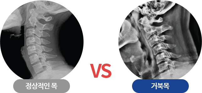모커리한방병원 정상적인목X-Ray VS 거북목X-Ray 이미지