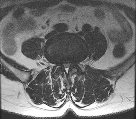 모커리한방병원 MRI로 본 정상적인 척추관 이미지