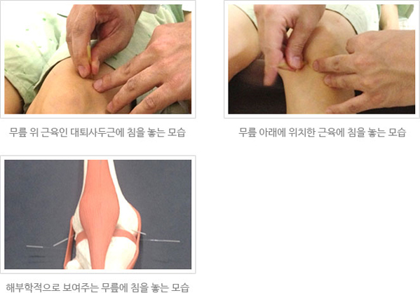 모커리한방병원 무릎 위 근육인 대퇴사두근에 침을 놓는 모습 / 무릎 아래에 위치한 근육에 침을 놓는 모습 / 해부학적으로 보여주는 무릎에 침을 놓는 모습 이미지