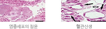 모커리한방병원 염증세포의 침윤 / 혈관신생 이미지