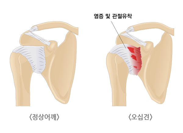 모커리한방병원 정상어깨 / 오십견 -염증 및 관절유착