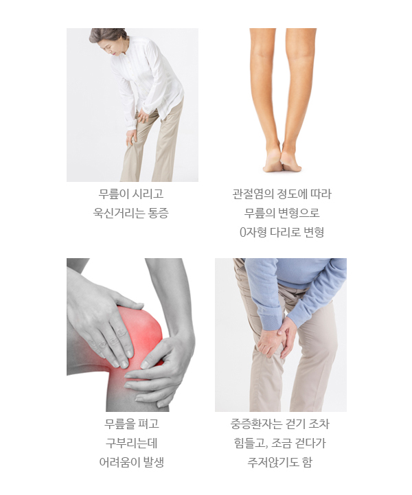 퇴행성 무릎관절염이 의심되는 퇴행성 무릎관절염 증상