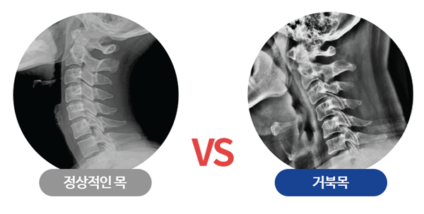 모커리한방병원 정상적인목X-Ray VS 거북목X-Ray 이미지