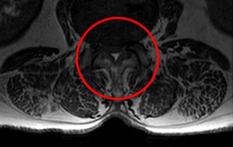 모커리한방병원 MRI로 본 중증 척추관협착증 이미지