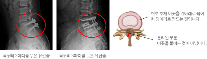 모커리한방병원 척추뼈 2마디를 묶은 유합술 / 척추뼈 3마디를 묶은 유합술